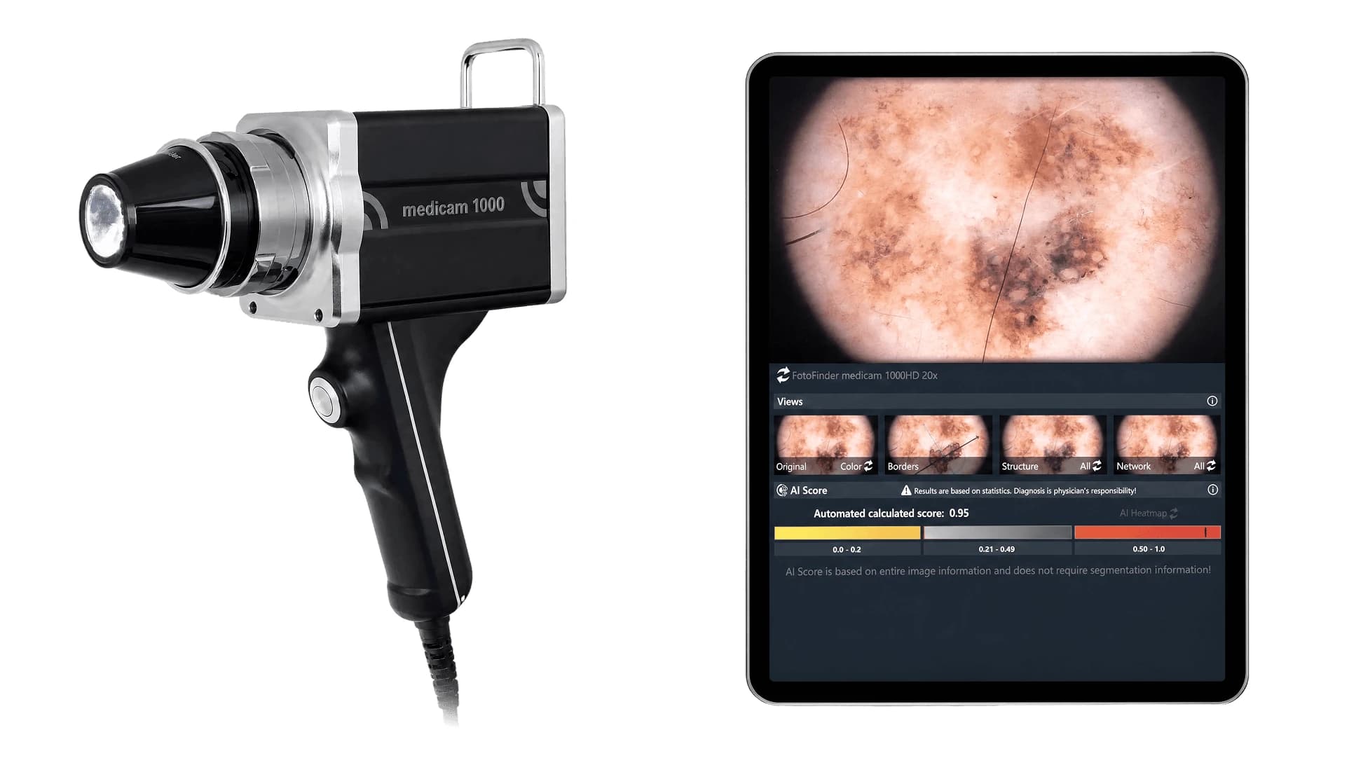 FotoFinder medicam 1000 e a análise de dermatoscopia digital na tela